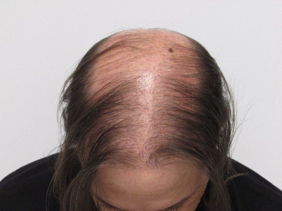 Hair Transplant Lies 5 Biggest Myths About Hair Restoration Hair